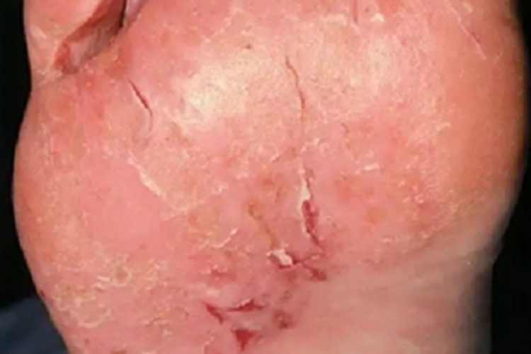 更年期角皮症出血图