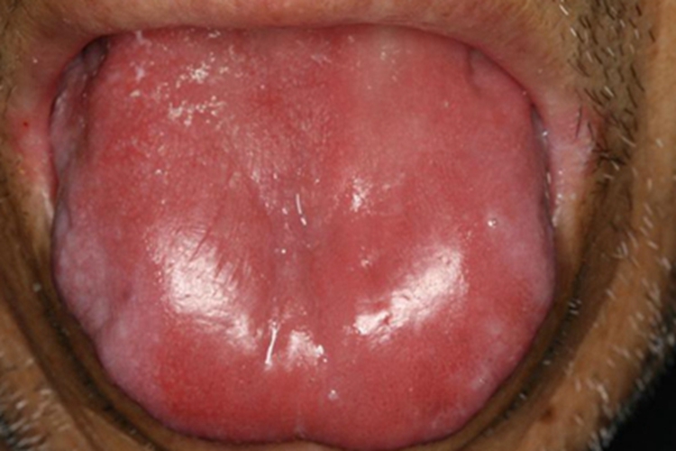 叶酸缺乏症舌头红肿图 叶酸缺乏症舌头红肿图