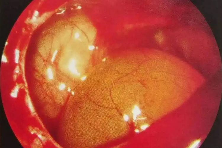 鼻内镜下鼻窦囊肿图 鼻内镜下鼻窦囊肿图