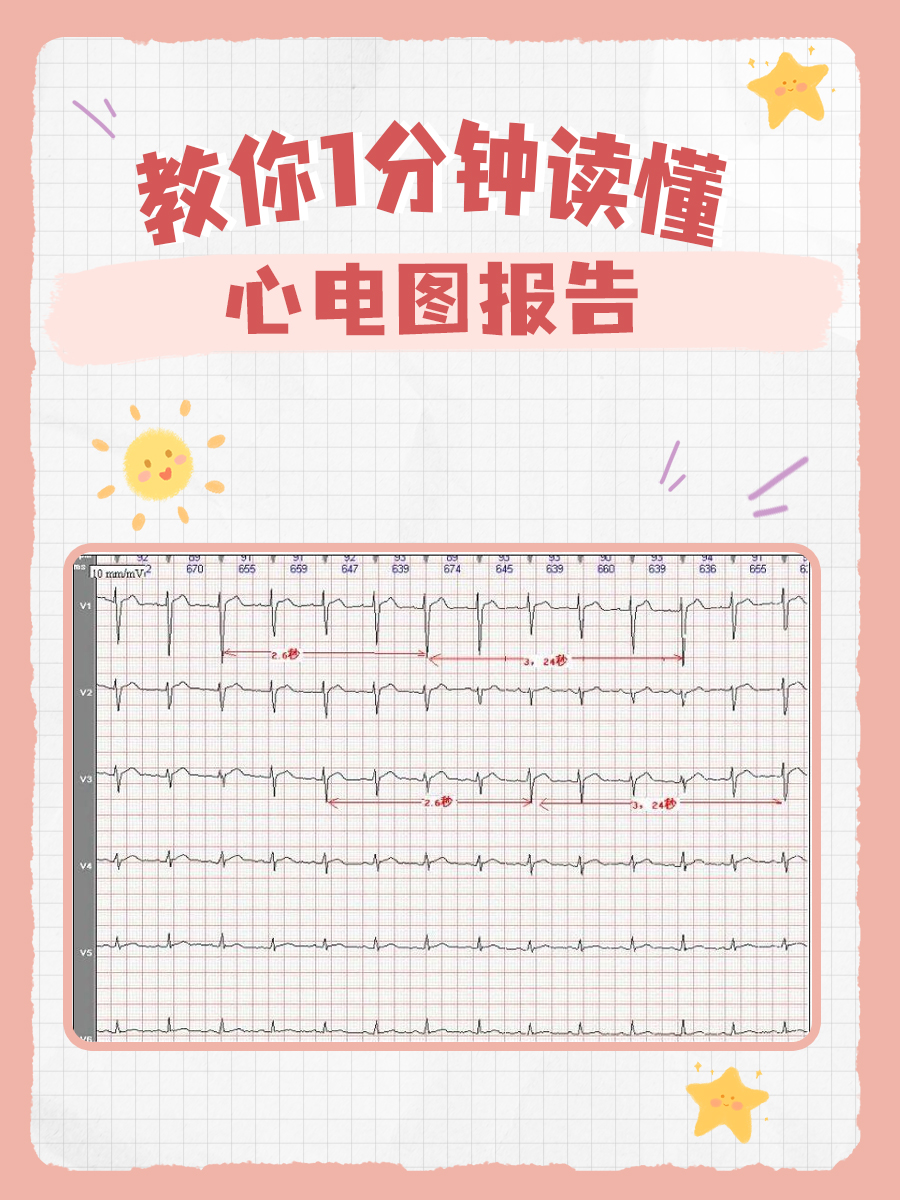 教你1分钟读懂心电图报告