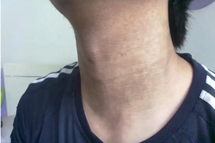 黑变病前颈皮肤颜色加深图