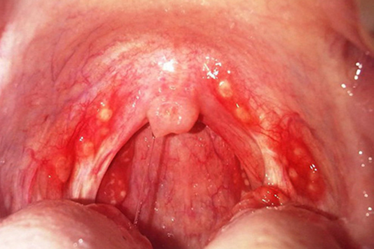 喉咙处黏膜表面的白色渗出物图