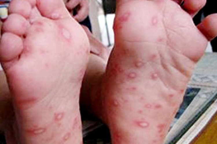 手足口病足底水泡图