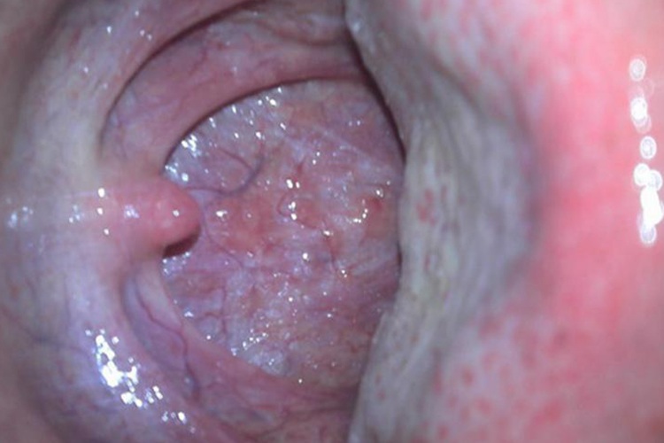 儿童正常扁桃体图