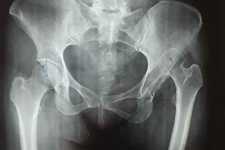 髋关节脱位图