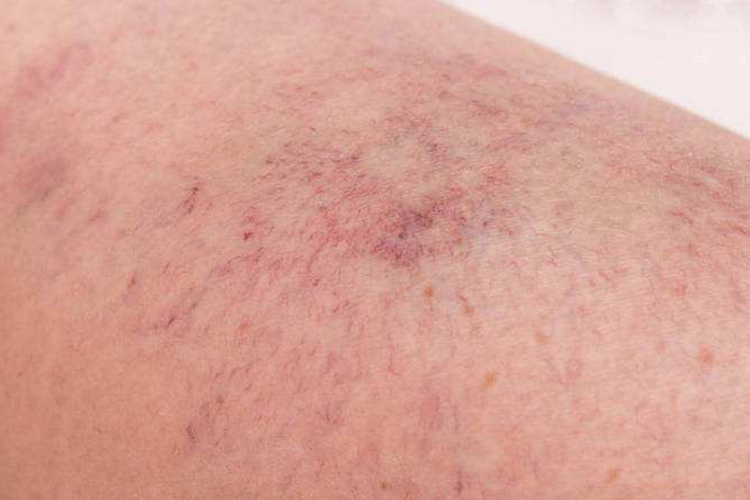 遗传性出血性毛细血管扩张症图