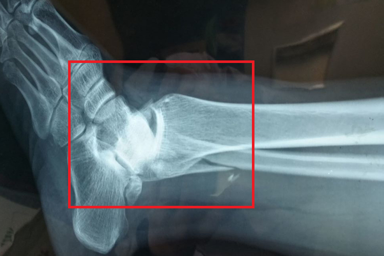 脚踝骨折X线图