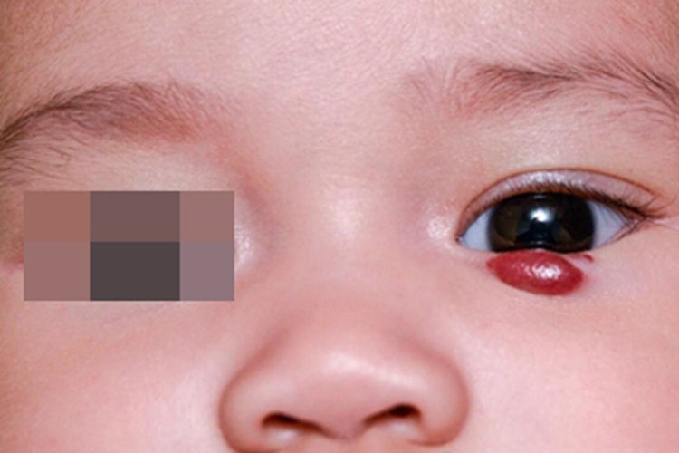 蔓状血管瘤眼睑疙瘩图 蔓状血管瘤眼睑疙瘩图