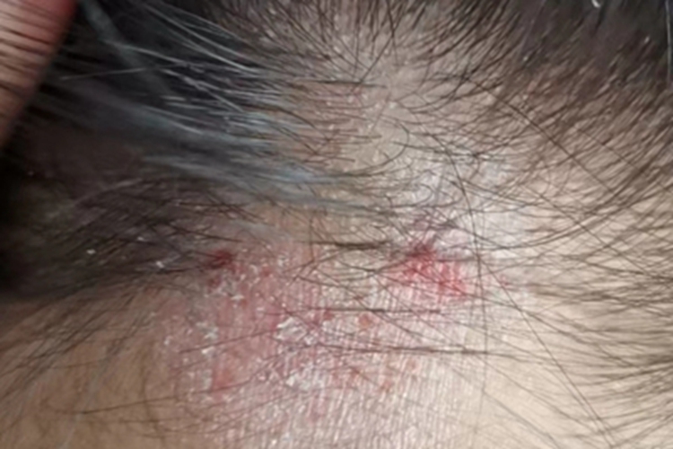 成人脂溢性皮炎前额结痂图