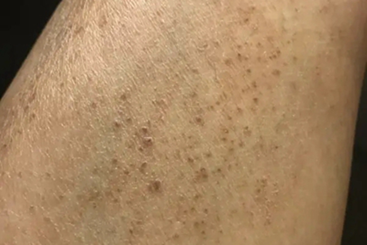 网状肢端色素沉着症状图 网状肢端色素沉着症状图