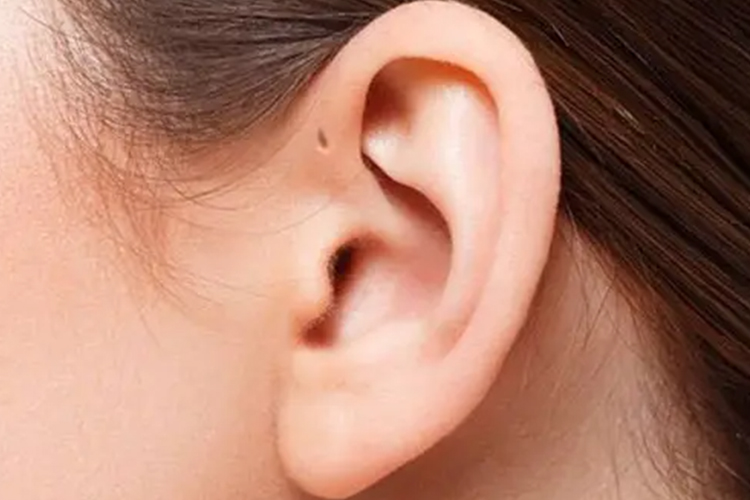 先天性耳前瘘管畸形图