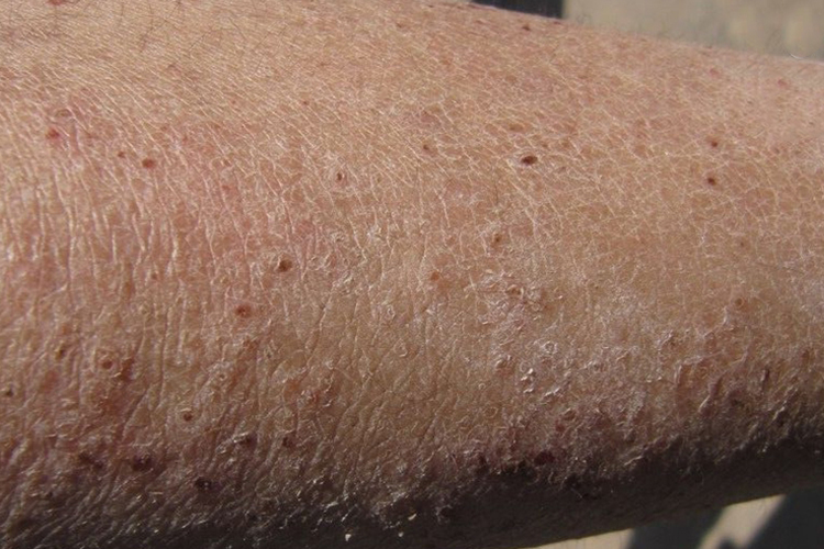 乏脂性湿疹腿上一片红点图