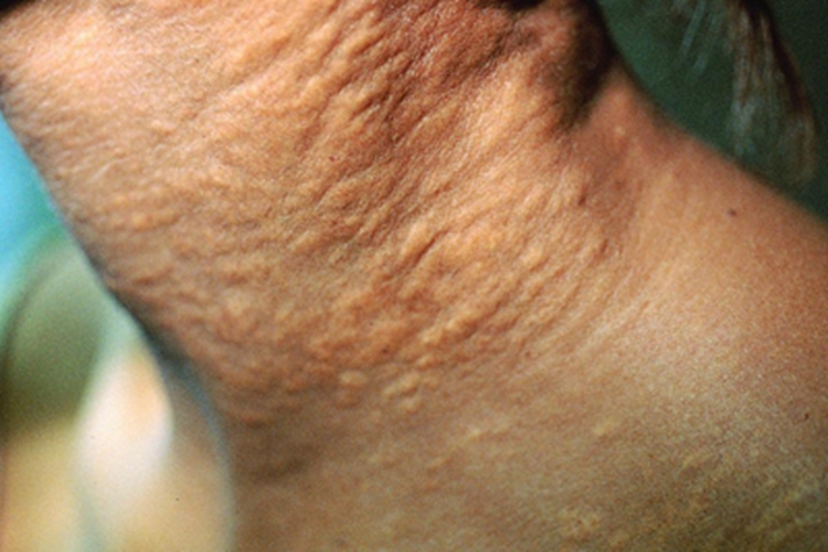 弹性假黄瘤疙瘩图