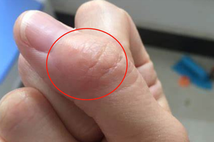 大拇指骨刺手指肿胀图