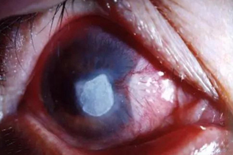 角膜挫伤角膜症状图 角膜挫伤角膜症状图