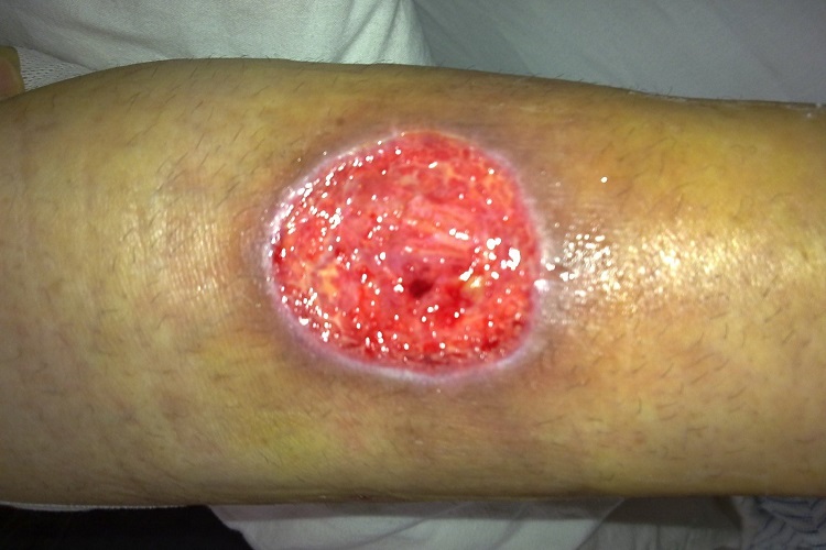 急性网状淋巴管炎小腿溃疡图