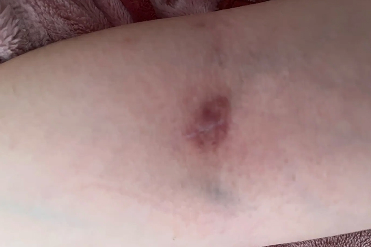 免拆线缝合线头脱落图