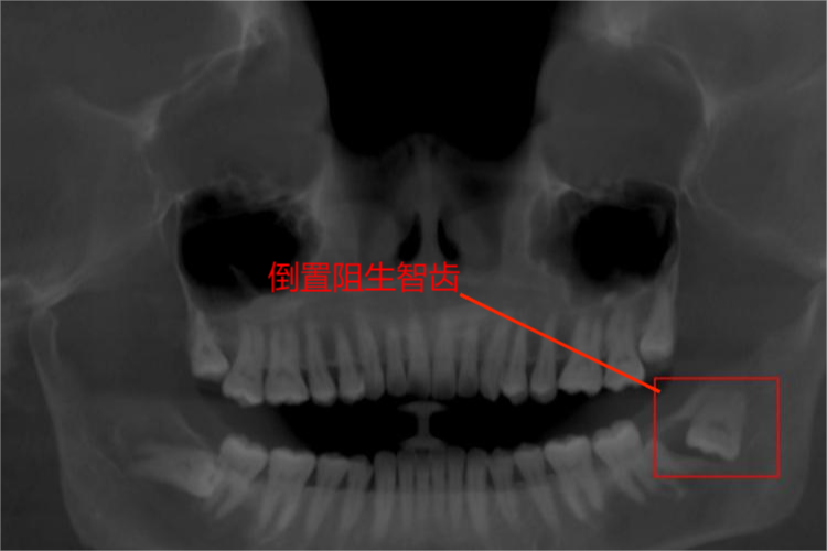 倒置阻生智齿图