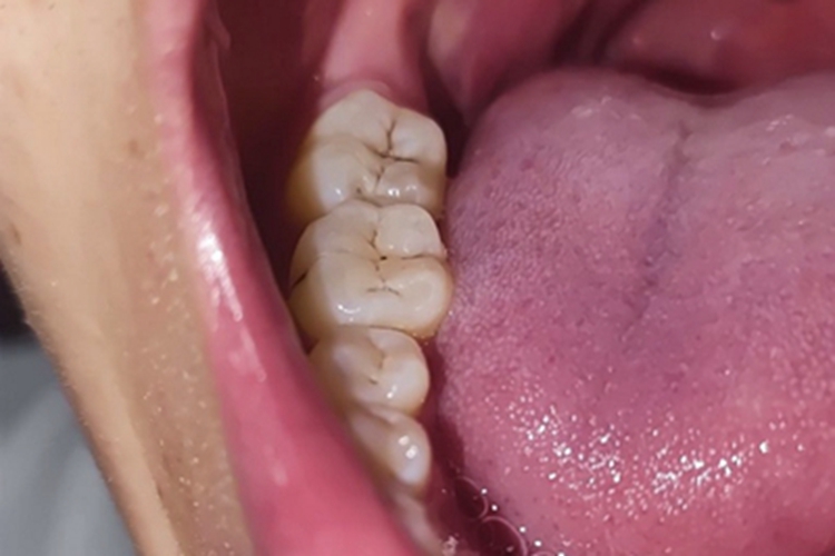 浅龋牙齿纹图 浅龋牙齿纹图