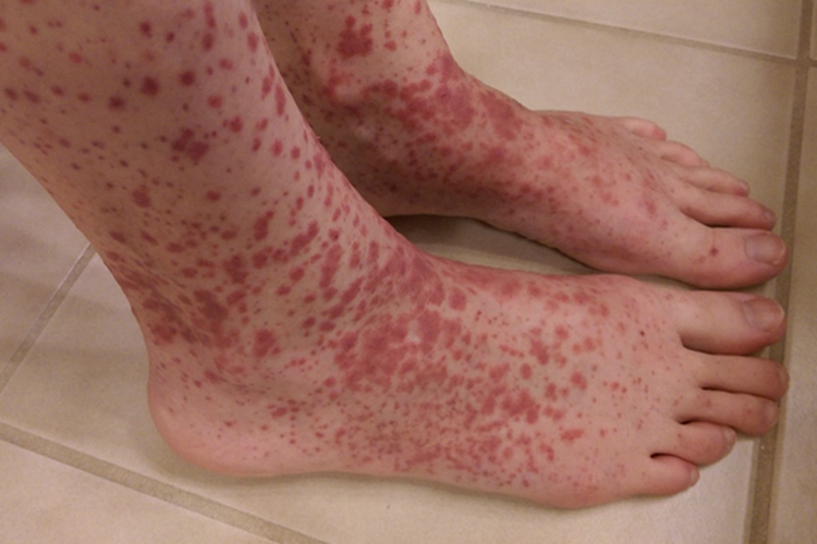 小儿过敏性紫癜脚背有密集红斑图