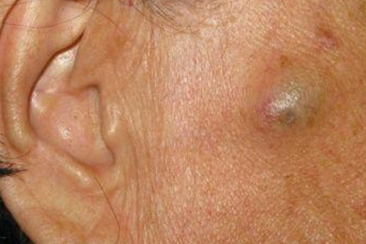 脸上皮样囊肿图