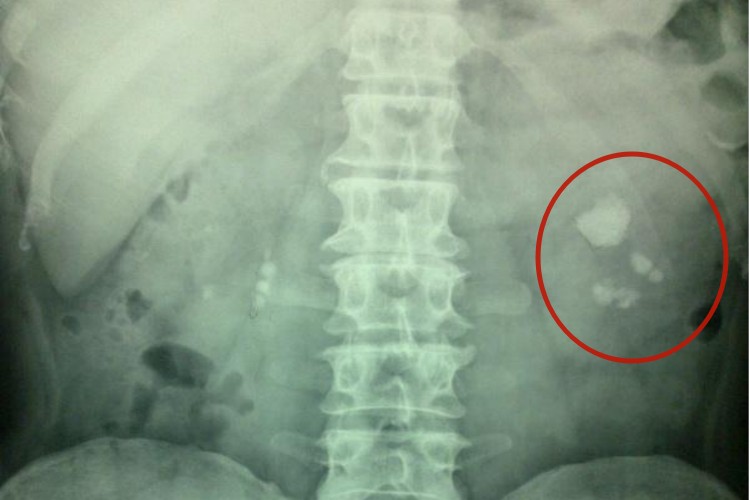 肾脏片状结石影像图