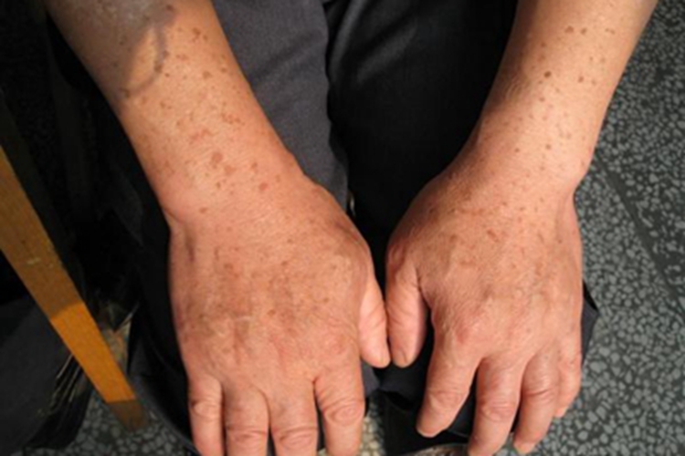 疣状肢端角化病症状图