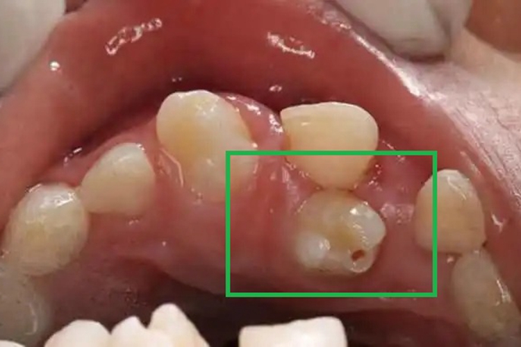 多生牙牙齿小孔图