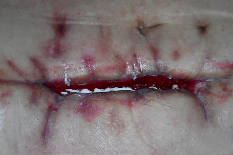 含脂滴的血性渗出液图 含脂滴的血性渗出液图