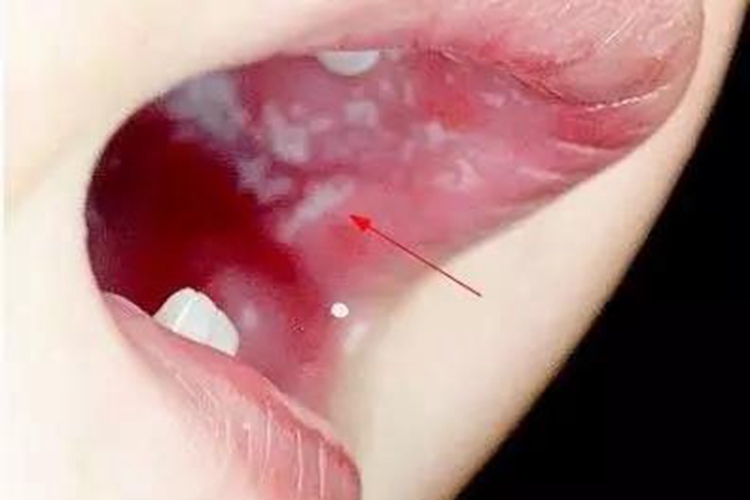 鹅口疮图