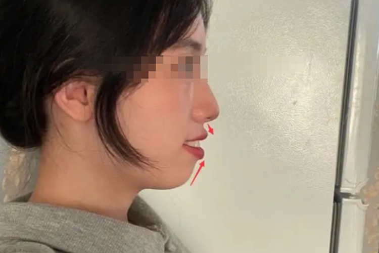 双颌前突严重骨性嘴凸图