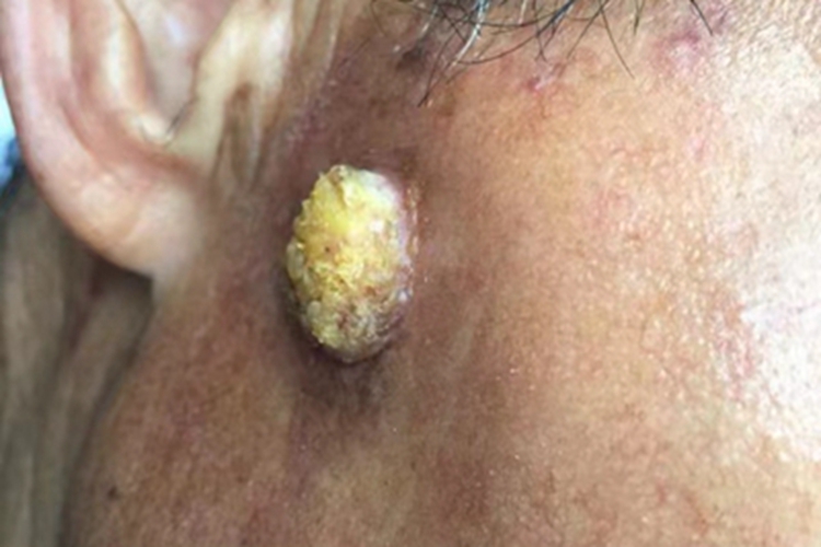 寻常疣耳周症状图 寻常疣耳周症状图