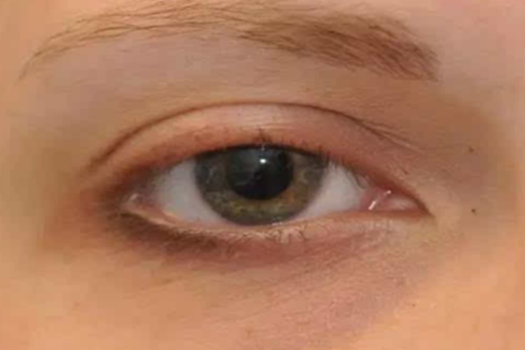 溃疡性睑缘炎毛发稀少图