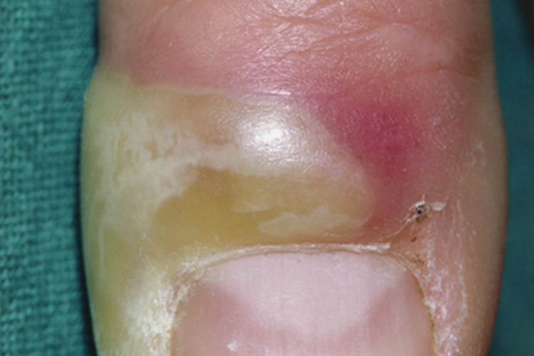 急性甲沟炎指甲旁边有脓包图