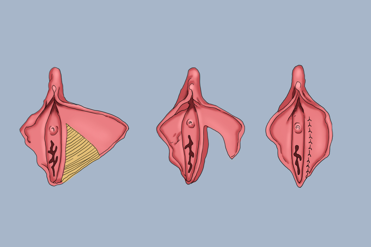 小阴唇成形术图