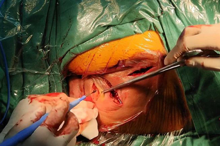 肛门脓肿手术切开引流图