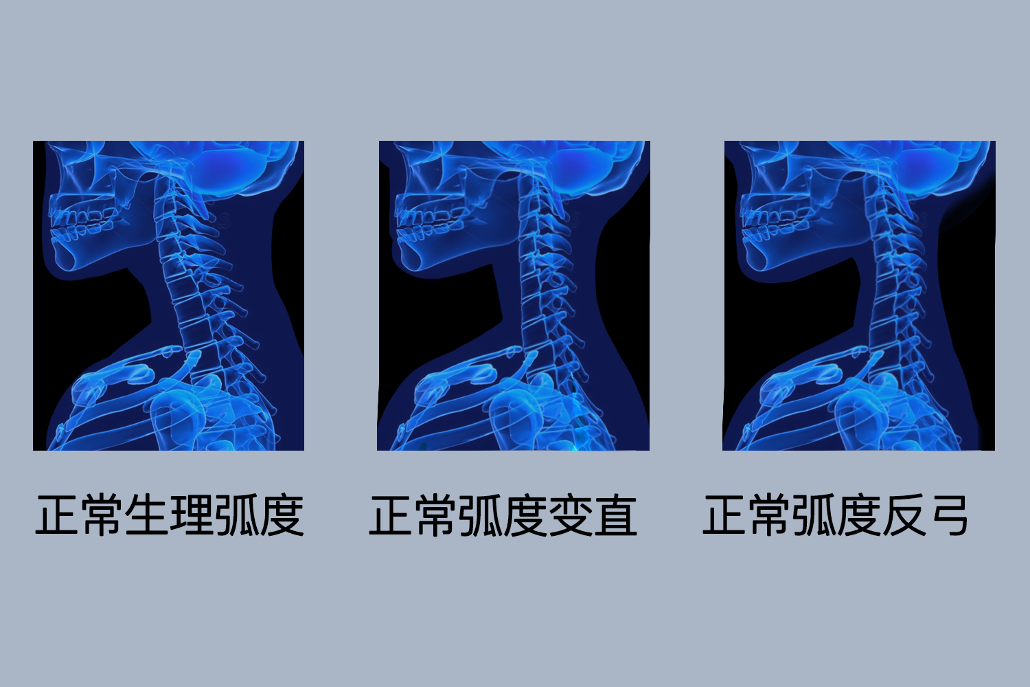脖子前倾X线对比图
