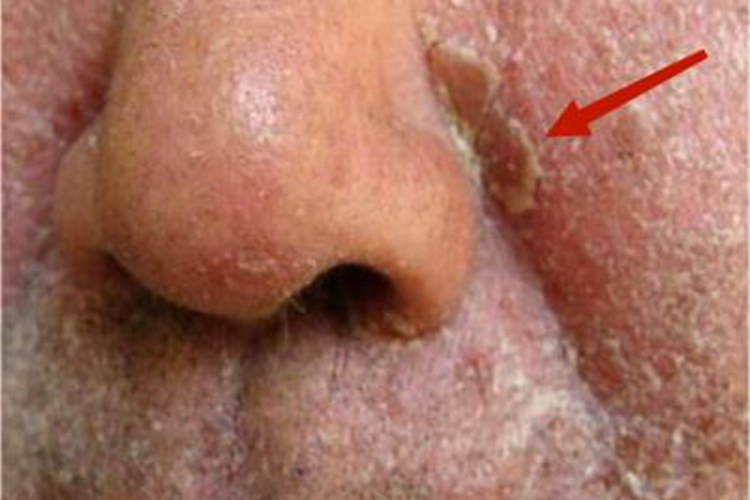 松皮癣鼻翼黄痂图 松皮癣鼻翼黄痂图