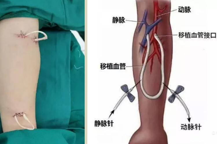 移植血管内瘘图