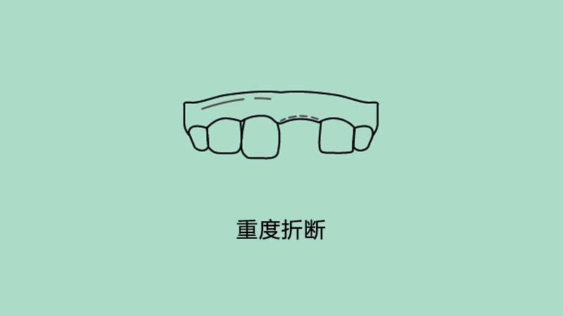 重度折断.png