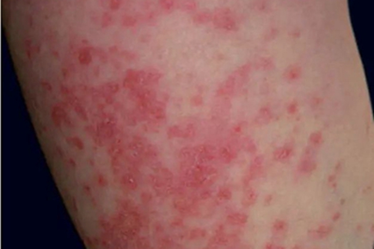 急性皮肤型红斑狼疮大腿红点图