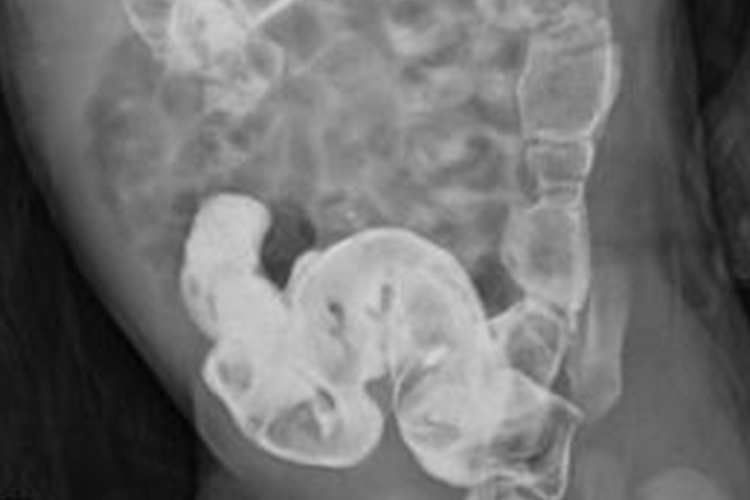 先天性巨结肠的影像图 先天性巨结肠的影像图