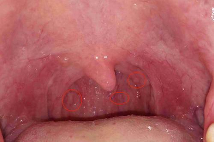 喉咙尖锐湿疣小疣体图