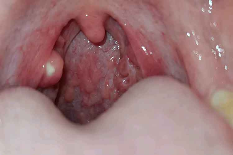 儿童慢性咽炎图