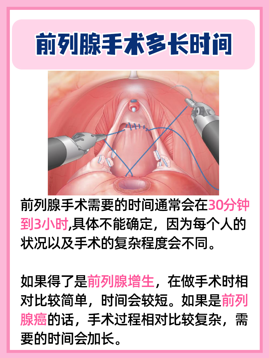 前列腺手术多长时间，医生解答！