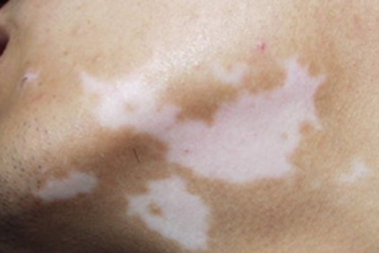 混合型白癜风下巴长白斑图