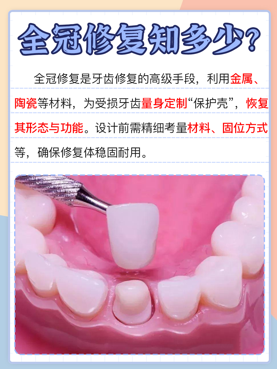 知识点get!医生揭秘全冠修复是什么意思