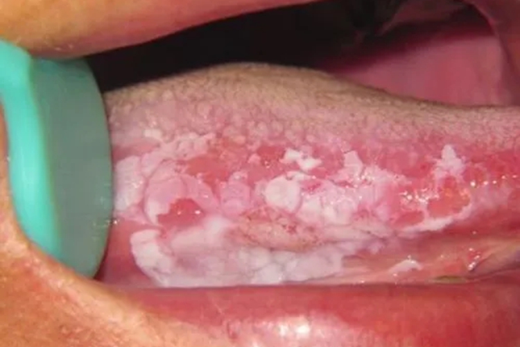 口腔黏膜白斑病图