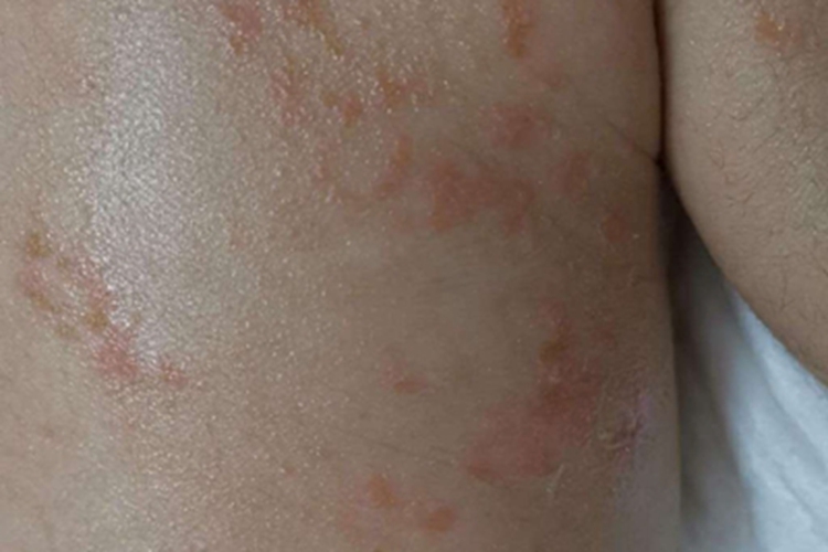 新生儿痤疮背部丘疹图