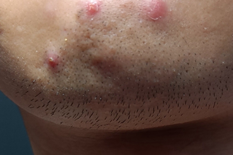 痤疮下巴上有几个大红疙瘩图